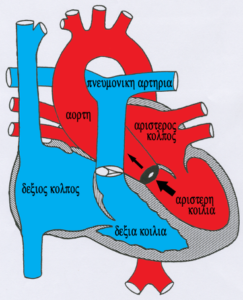 Aortic  Stenosis